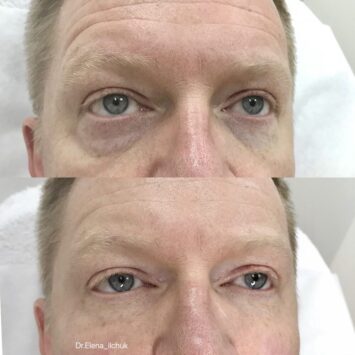 Коррекция носослёзной борозды филлером, 1 мл у мужчины до и после