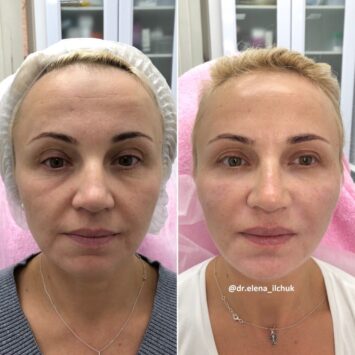 Комплексное омоложение лица «Full Face» результаты до и после