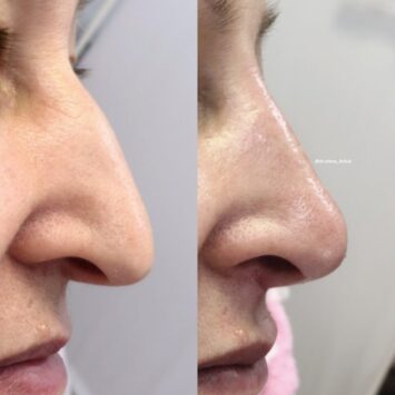 Коррекция горбинки филером (1мл) и поднятие кончика носа нитями до и после