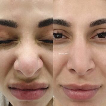 Сужение/уменьшение носа ботулотоксином до и после