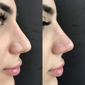 Коррекция носа филером (1мл) поднятие кончика носа до и после