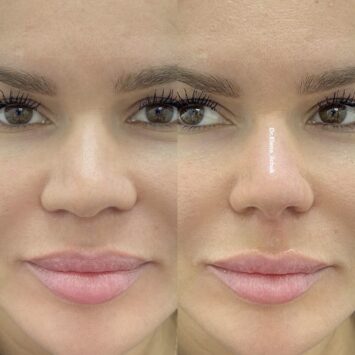 Сужение носа дренажным мезококтейлем до и после