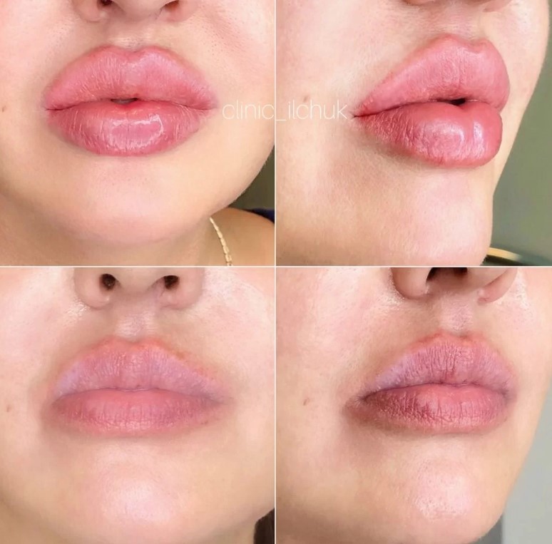 фото до и после контурной пластики губ у девушки