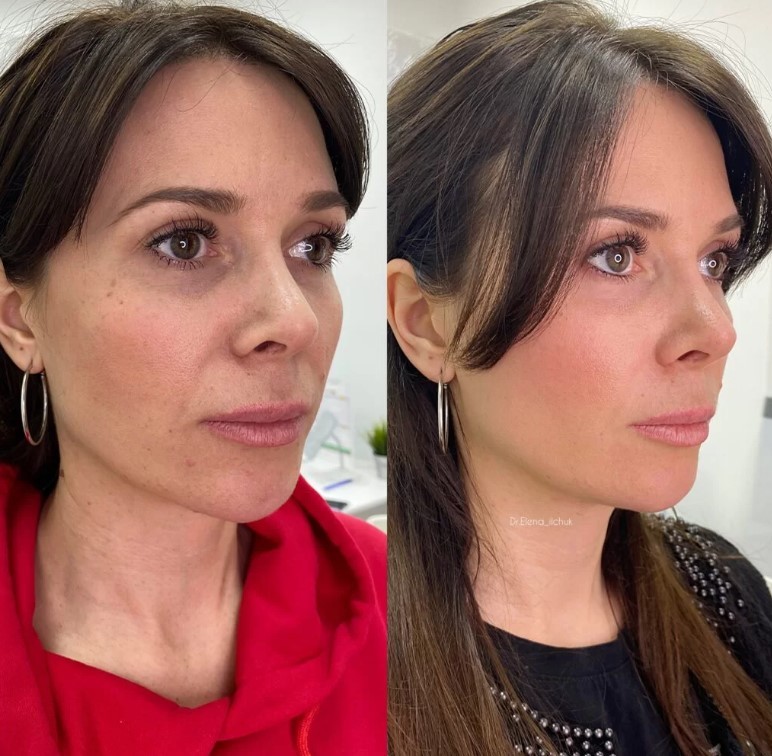 фото до и после лазерного омоложения лица