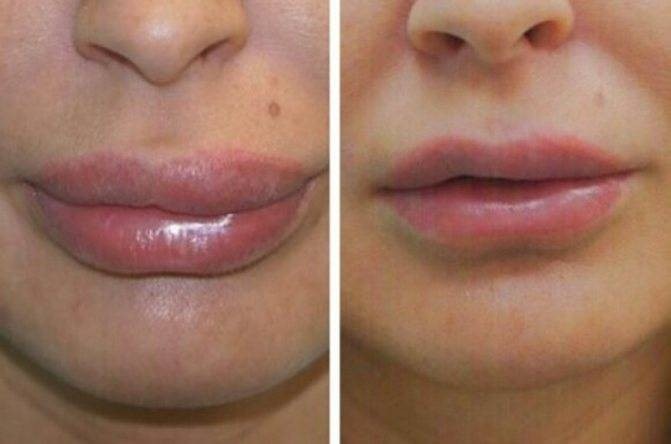 фото побочных эффектов после контурной пластики на губах