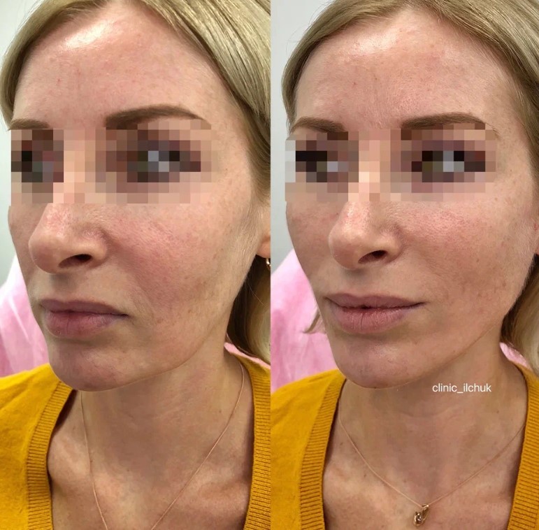 фото до и после плазмолифтинга лица